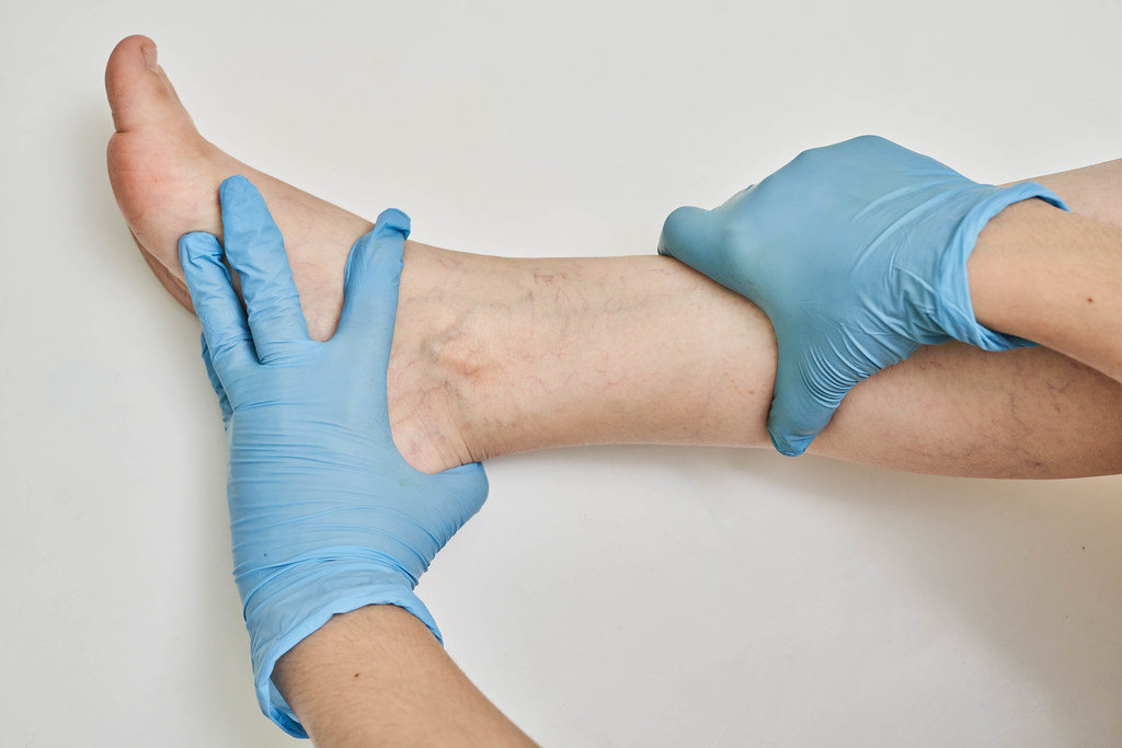 Road to Recovery: Treating and Repairing Damaged Veins